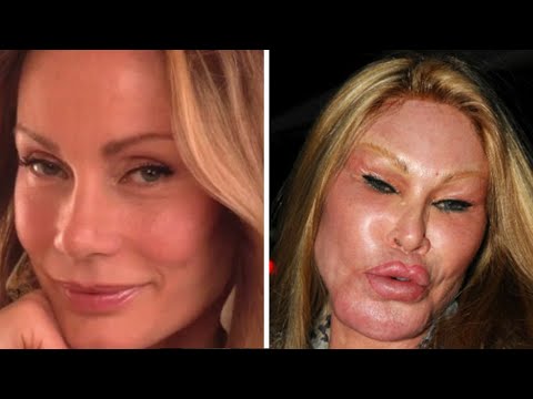 9 أشخاص حولتهم عمليات التجميل لـ”مسخ”